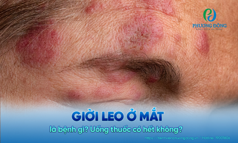 Giời leo ở mắt là bệnh gì? Uống thuốc có hết không?