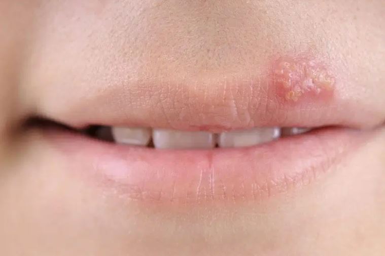 Herpes simplex: Làm sao để ngừng lây lan và giảm nguy cơ tái phát?