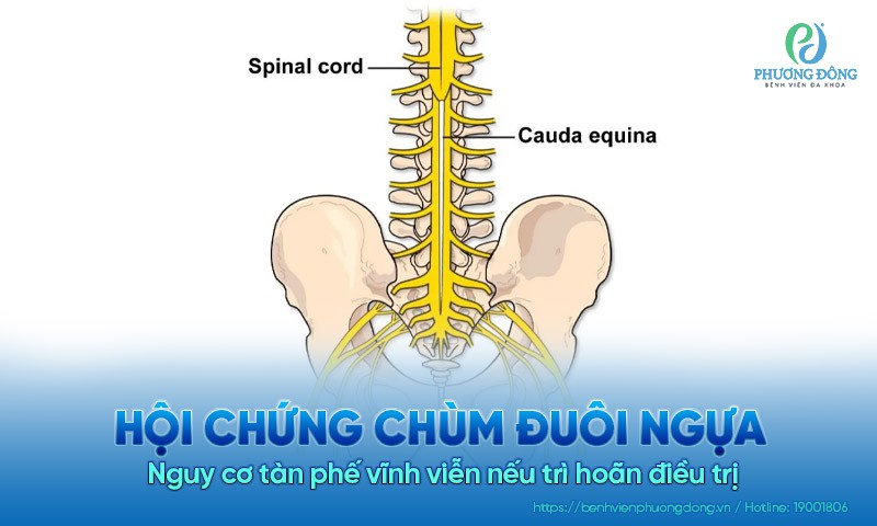 Hội chứng chùm đuôi ngựa: Nguy cơ tàn phế vĩnh viễn nếu trì hoãn điều trị