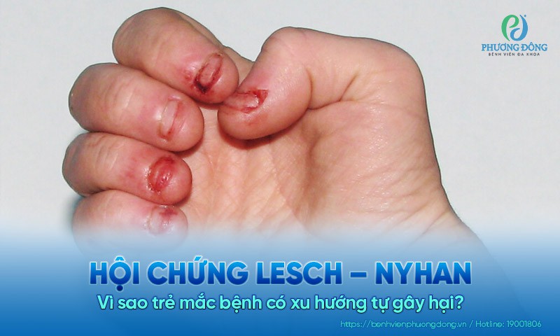 Hội chứng Lesch – Nyhan: Vì sao trẻ mắc bệnh có xu hướng tự gây hại?