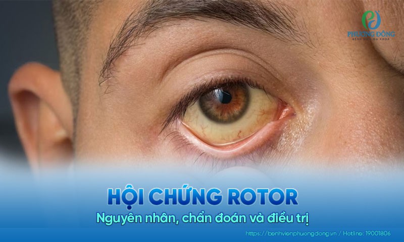 Hội chứng Rotor: Nguyên nhân, triệu chứng và cách điều trị