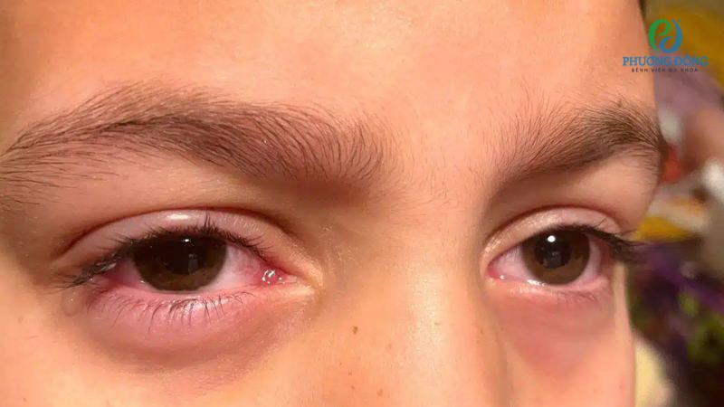 Hỏi - Đáp với bác sĩ: Đau mắt đỏ có bị tái phát không?