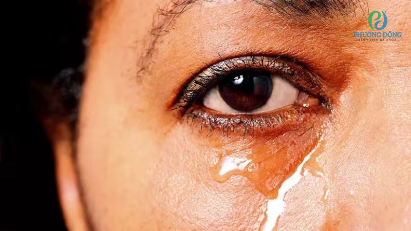 Giải đáp cùng bác sĩ: Khóc nhiều có bị mù mắt không?