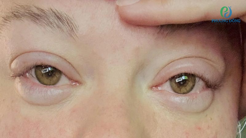 Một số cách để mắt bớt sưng sau khi khóc