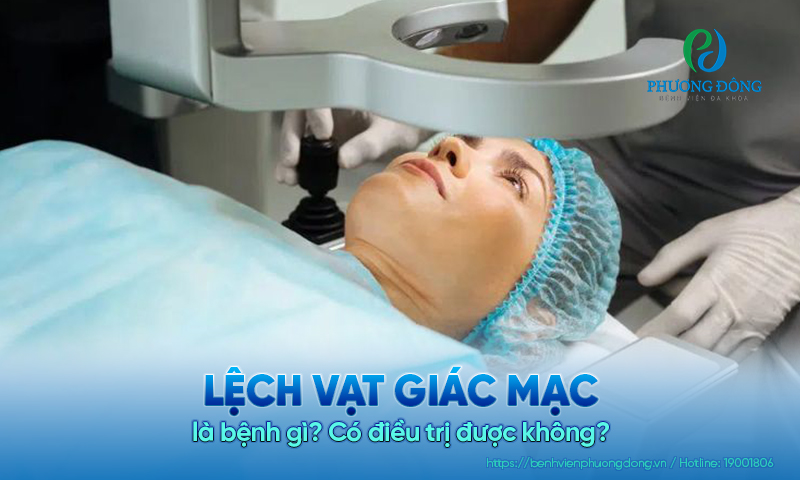 Lệch vạt giác mạc là bệnh gì? Có điều trị được không?
