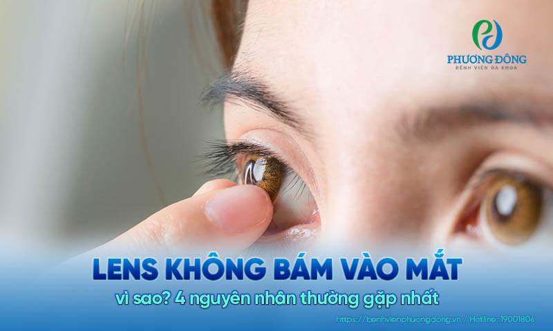 Lens không bám vào mắt vì sao? 4 nguyên nhân thường gặp nhất