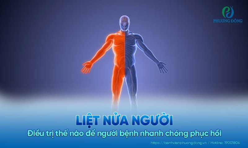 Liệt nửa người: Điều trị thế nào để người bệnh nhanh chóng phục hồi 