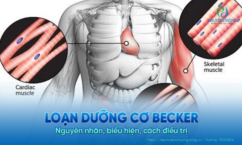 Loạn dưỡng cơ Becker: Nguyên nhân, biểu hiện, cách điều trị