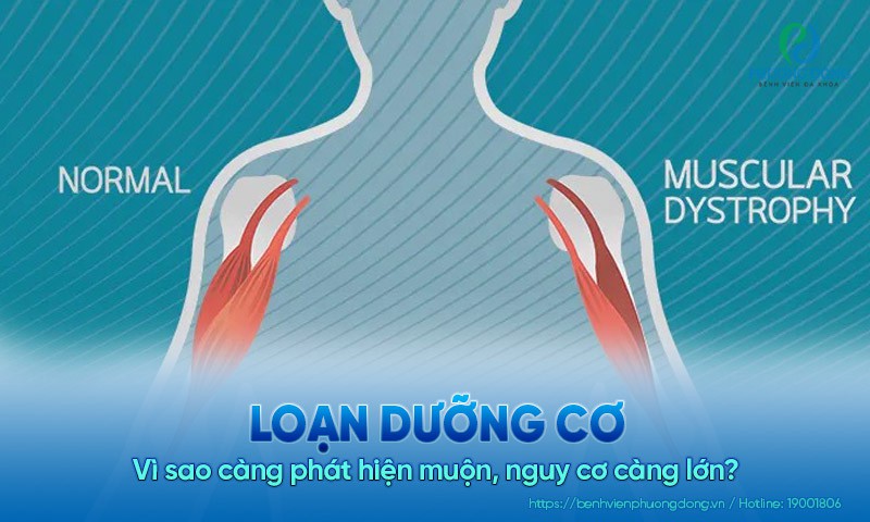 Loạn dưỡng cơ: Vì sao càng phát hiện muộn, nguy cơ càng lớn?