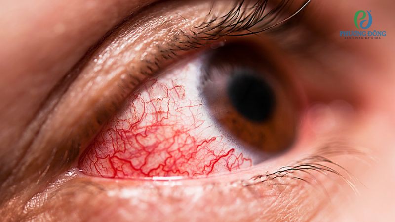 Tròng trắng nhiều mạch máu đỏ nếu điều trị đúng cách sẽ không ảnh hưởng đến sức khoẻ