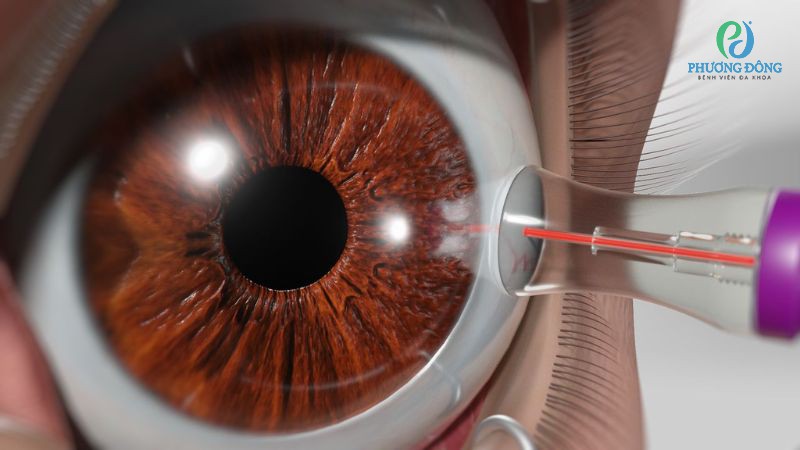 Điều trị ngoại khoa cườm nước bằng tia laser