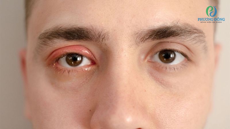 Các bệnh lý về mắt khiến mí mắt co thắt thường xuyên, không tự chủ