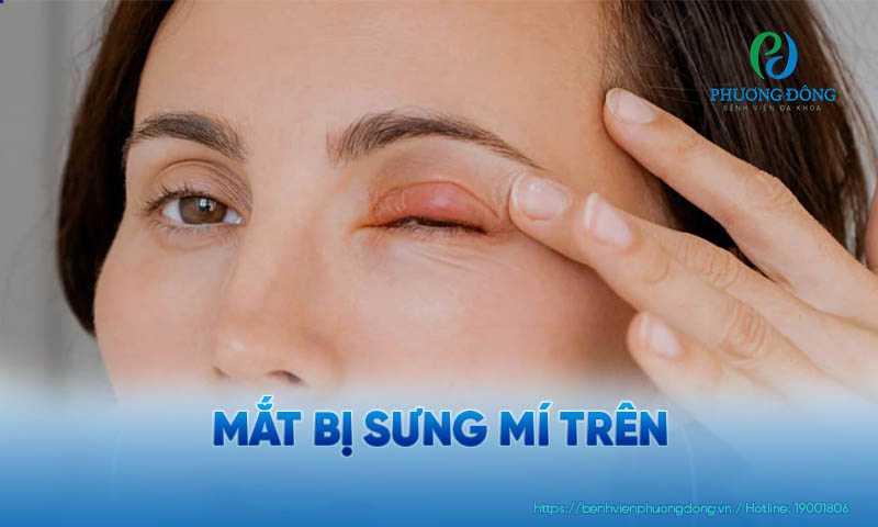 Mí mắt trên bị sưng là triệu chứng thường gặp