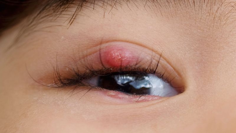 Lẹo là một trong số các nguyên nhân gây sưng mí mắt phổ biến