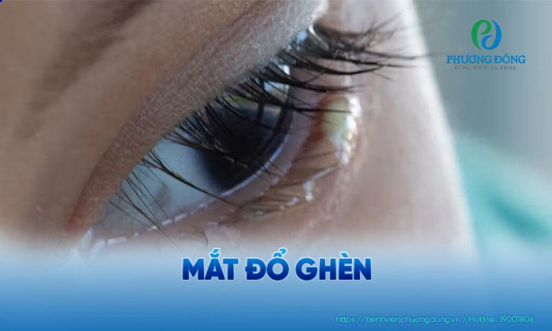 Ghèn mắt có thể ở dạng ướt, dính hoặc khô cứng