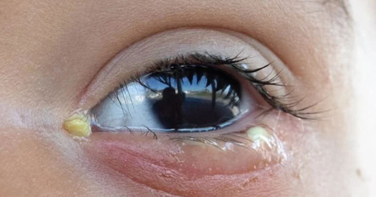 Ghèn dạng nhầy là một trong số các loại ghèn thường gặp ở người bị viêm kết mạc