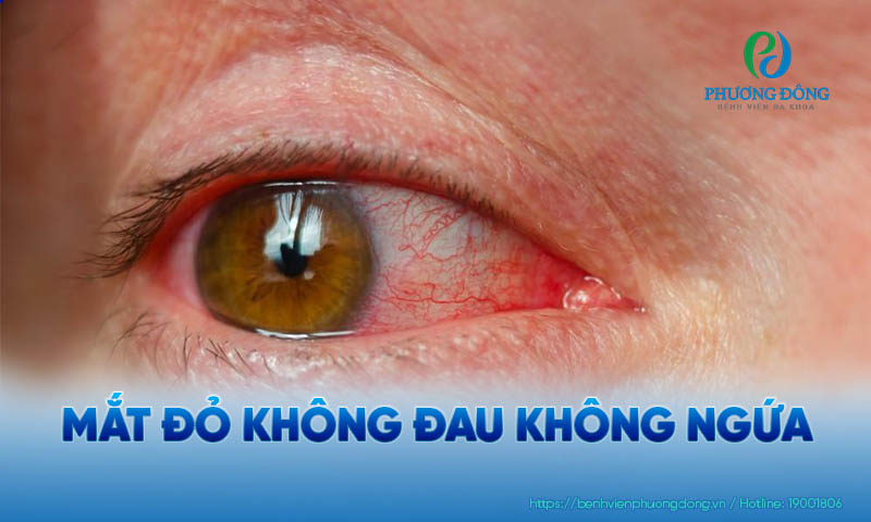 Tình trạng mắt bị đỏ nhưng không đau không ngứa khá phổ biến