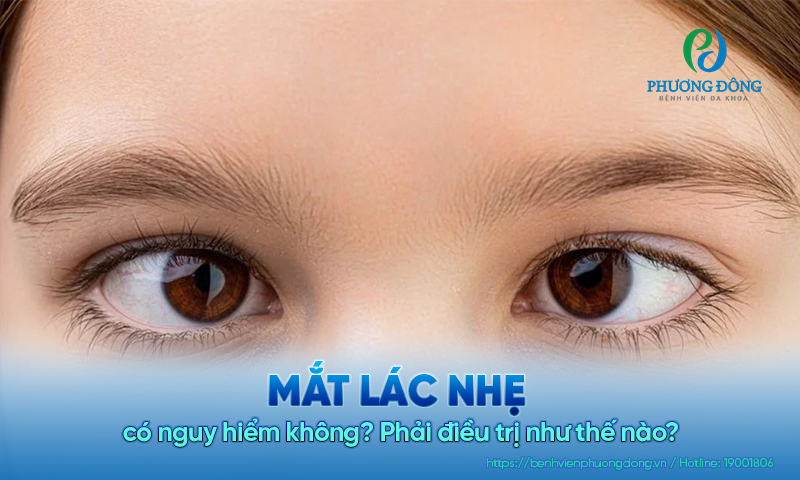 Mắt lác nhẹ có nguy hiểm không? Phải điều trị như thế nào?