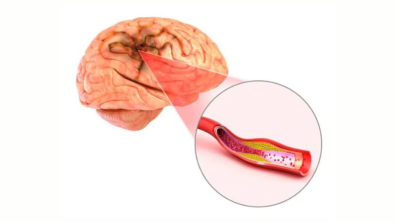 Thiếu máu lên não cũng có thể khiến người bệnh tạm thời nhìn không rõ