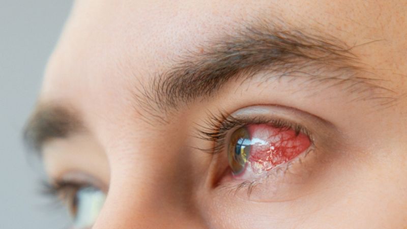 Tổn thương giác mạc cũng khiến người bệnh nhìn mờ