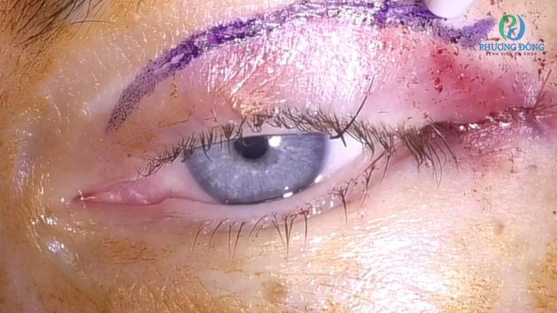 Thẩm mỹ mí mắt thất bại là một trong những nguyên nhân hàng khiến mắt sụp mí