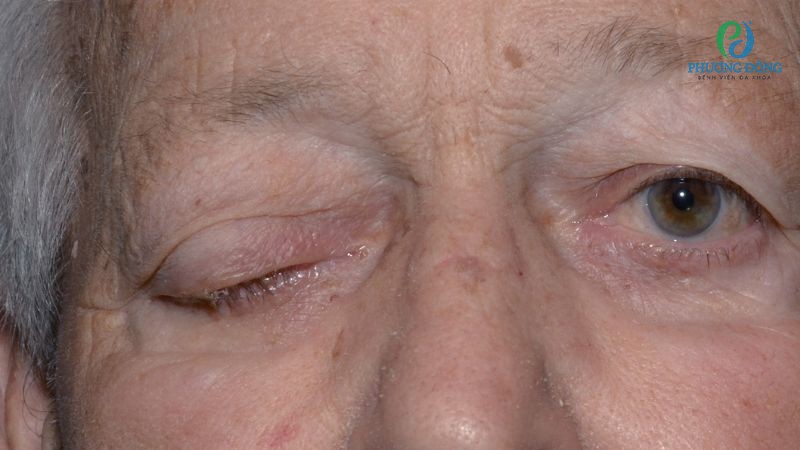 Dấu hiệu nhận biết sụp mí mắt ở người cao tuổi