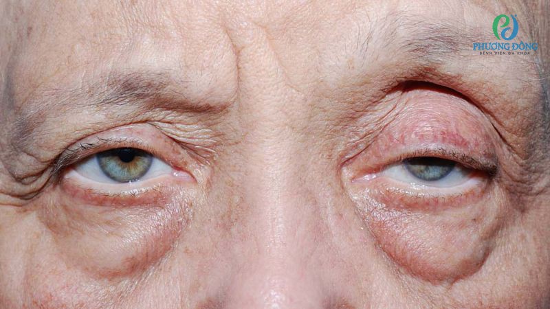 Sụp mí 1 bên thường xuất hiện ở người gặp chấn thương, lão hoá hoặc mắc các rối loạn chức năng