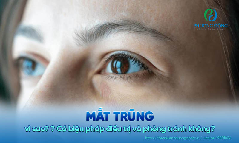Mắt trũng là gì? Làm thế nào để cải thiện tình trạng này ở nhà?