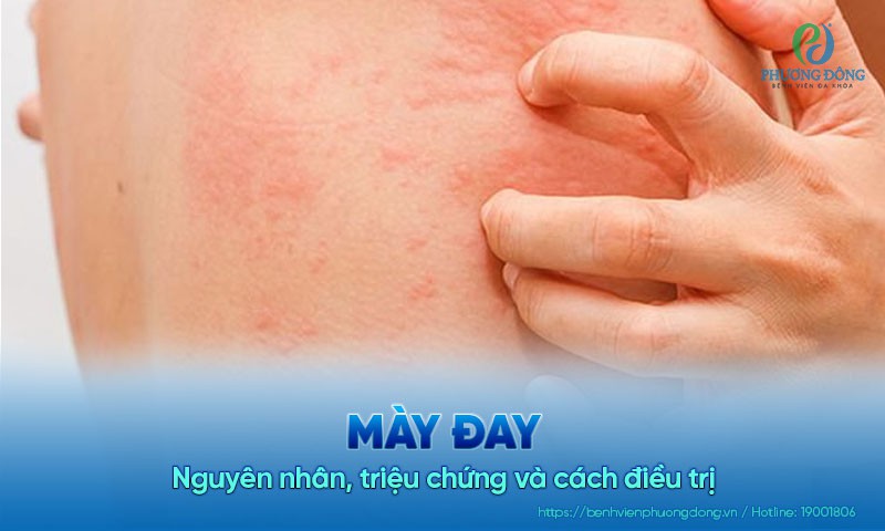 Mày đay: Nguyên nhân, triệu chứng và cách điều trị