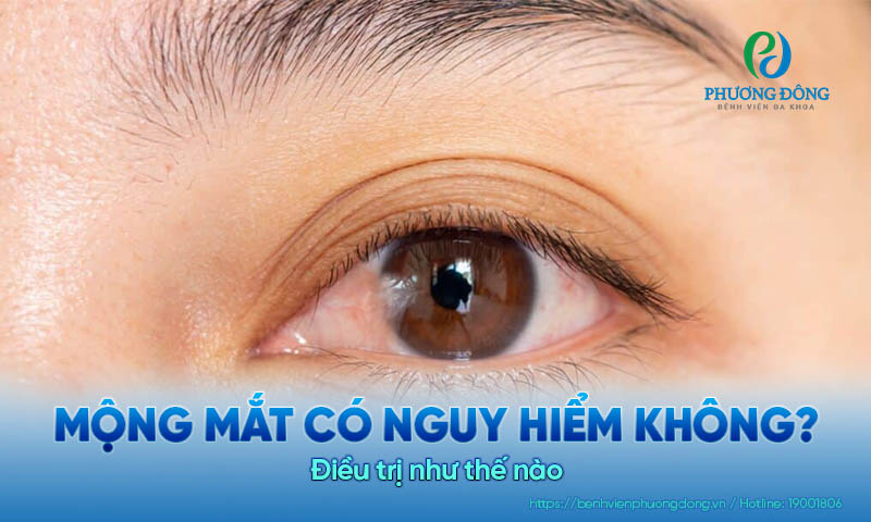 Mộng mắt có nguy hiểm không? Điều trị như thế nào