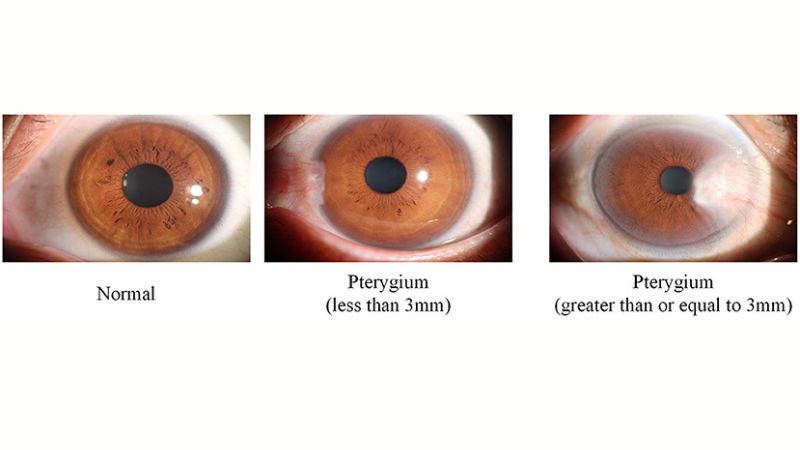 Dựa vào mức độ xâm lấn, mộng mắt có thể chia thành 3 cấp độ khác nhau