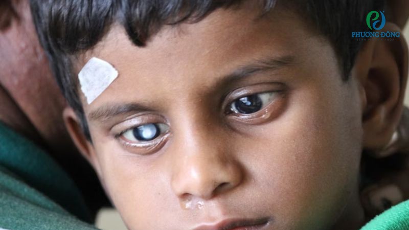 Nhóm bệnh lý làm tăng nguy cơ hình thành mù mắt