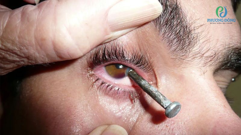 Chấn thương là một trong những nguyên nhân làm mất thị lực