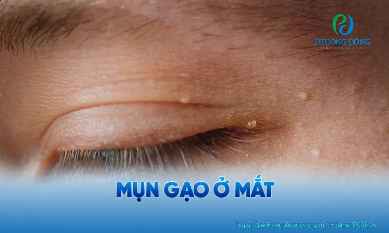 Triệu chứng có mụn ở mất khá thường gặp