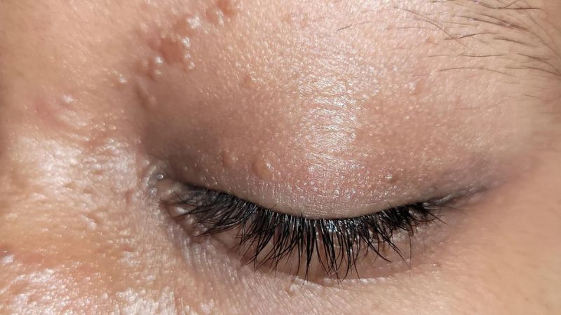 Mụn gạo không tự hết mà phải điều trị