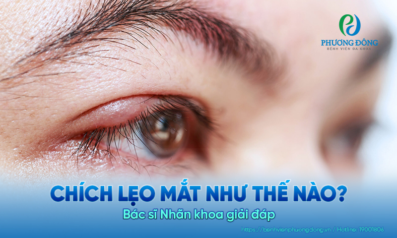 Bác sĩ Nhãn khoa trả lời: Chích lẹo mắt như thế nào?