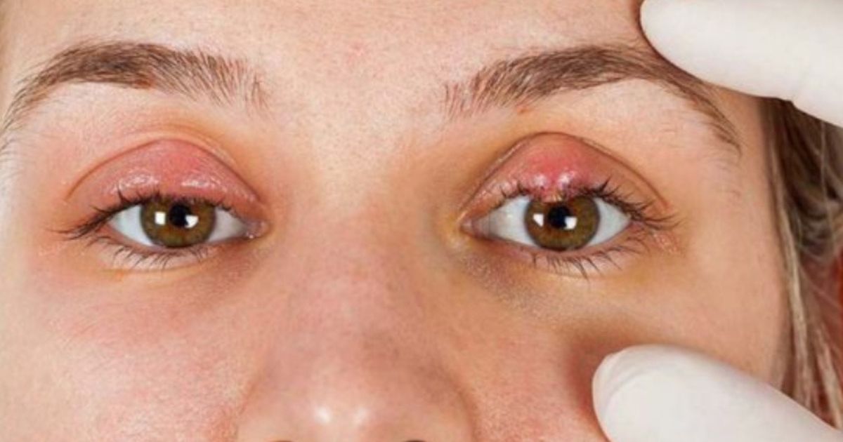 Bạn sẽ được gây tê trước khi thực hiện thủ thuật 