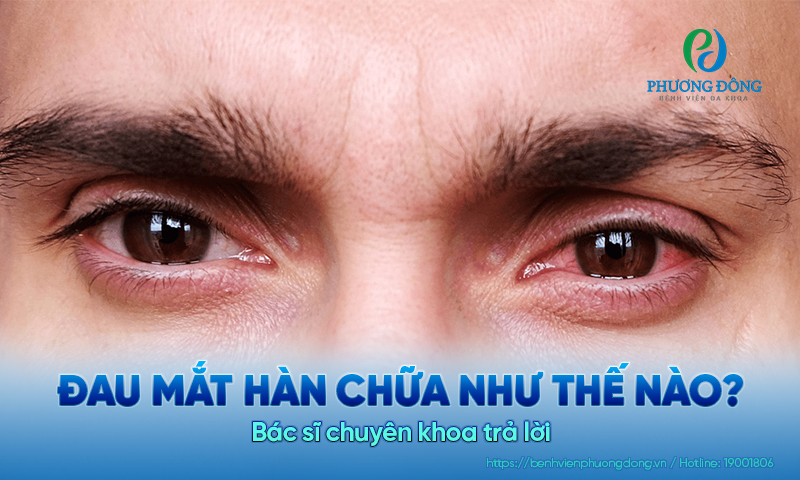 Bác sĩ chuyên khoa trả lời: Đau mắt hàn chữa như thế nào?