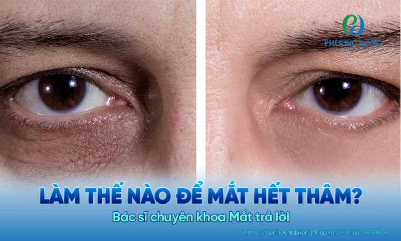Bác sĩ chuyên khoa Mắt trả lời: Làm thế nào để mắt hết thâm?