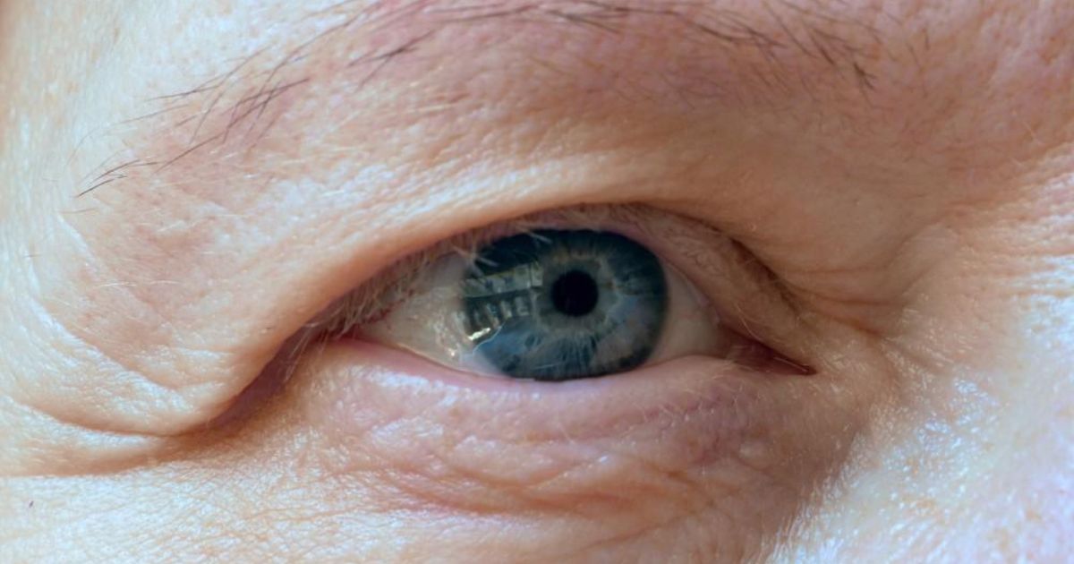 Mắt mí lót là mắt không thấy rõ nếp gấp mí