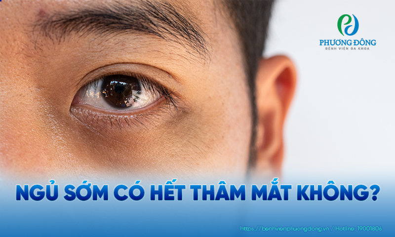 Có rất nhiều nguyên nhân khiến bạn bị thâm mắt