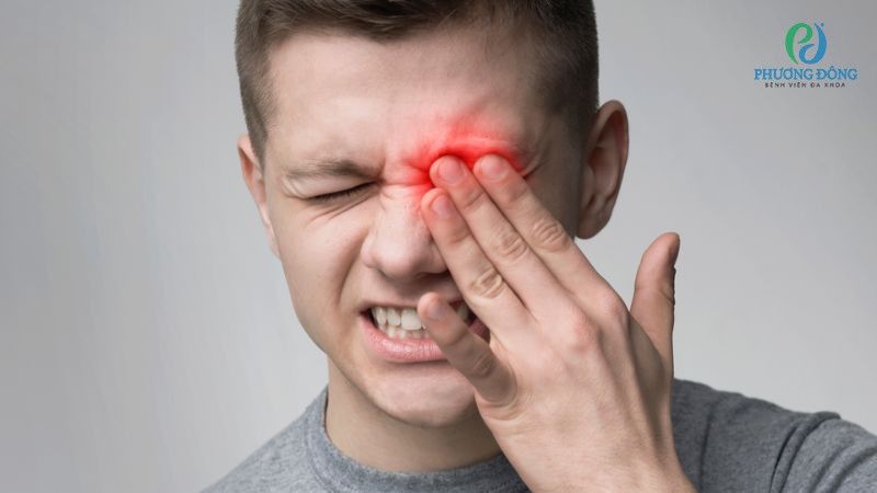 Nhức 1 bên mắt do chấn thương thường kèm tình trạng bầm tím, sưng đau, đỏ mắt