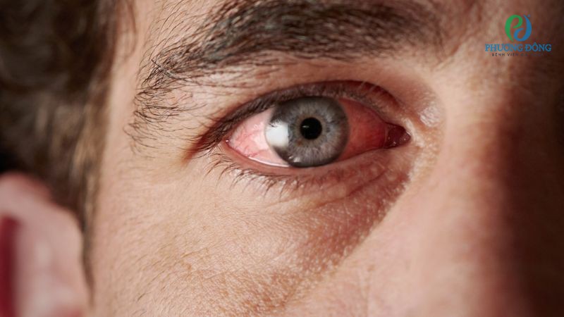 Nhiều trường hợp đau mắt đỏ khiến một bên ảnh hưởng đau nhức dữ dội