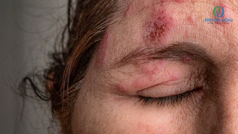 Bệnh zona thần kinh ở mắt gây tình trạng đau nhức, đau rát và ngứa sâu bên trong