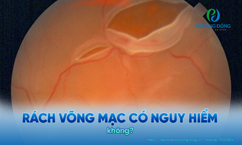 Mức độ nguy hiểm của rách võng mạc phụ thuộc vào nhiều yếu tố