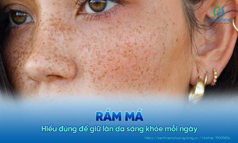 Rám má: Hiểu đúng để giữ làn da sáng khỏe mỗi ngày