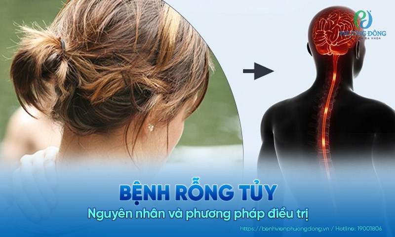Bệnh rỗng tủy là gì? Nguyên nhân và phương pháp điều trị