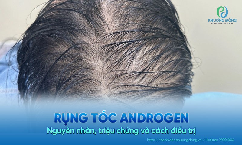 Rụng tóc androgen: Nguyên nhân, triệu chứng và cách điều trị