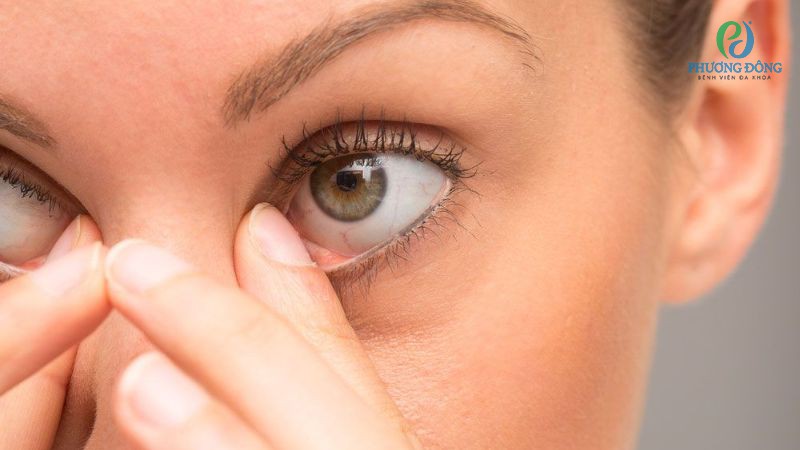 Sạn vôi thường gây các triệu chứng cộm, xốn khó chịu ở mắt