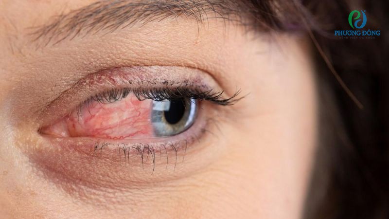 Nhóm nguyên nhân hàng đầu khiến kết mạc mắt tích tụ calci